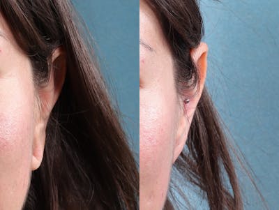 Earlobe Repair Before & After Gallery - Patient 244986 - Image 6