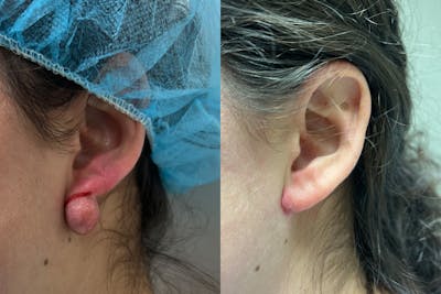 Earlobe Repair Before & After Gallery - Patient 206734 - Image 1