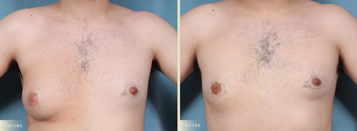 Male Breast Reduction (Gynecomastia) Before & After Gallery - Patient 205100 - Image 1