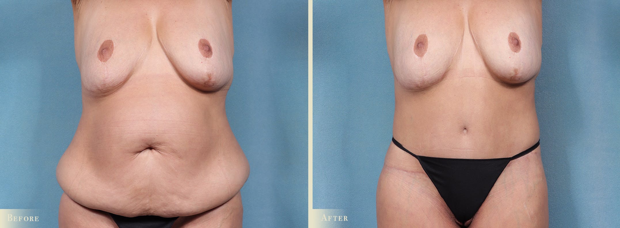 Body Lift Before & After Gallery - Patient 198122 - Image 1