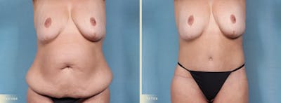 Body Lift Before & After Gallery - Patient 198122 - Image 1