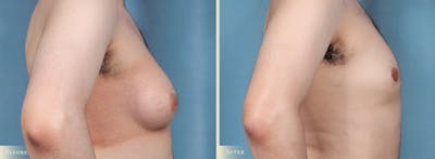 Male Breast Reduction (Gynecomastia) Before & After Gallery - Patient 205100 - Image 3