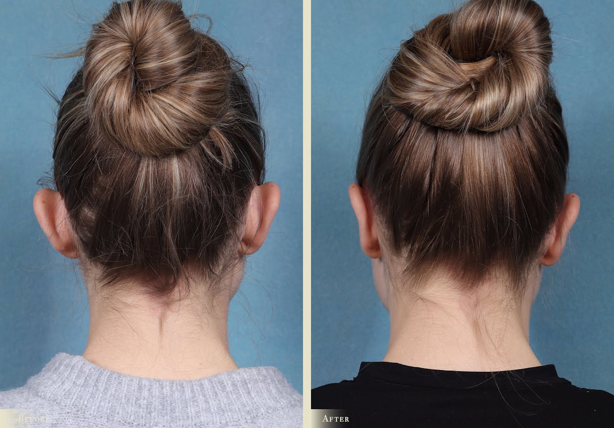 Ear Surgery Before & After Gallery - Patient 245710 - Image 2