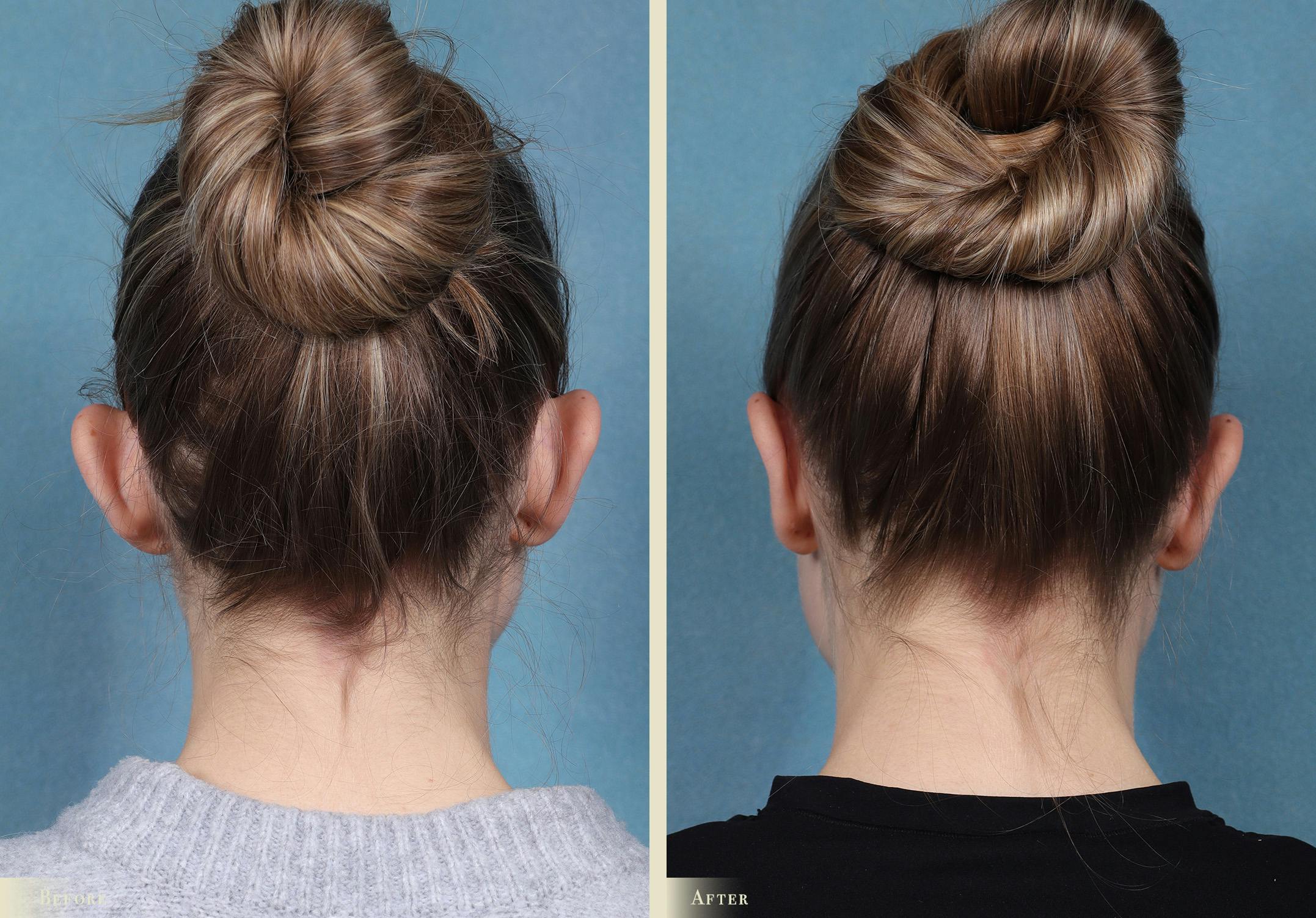 Ear Surgery Before & After Gallery - Patient 245710 - Image 2