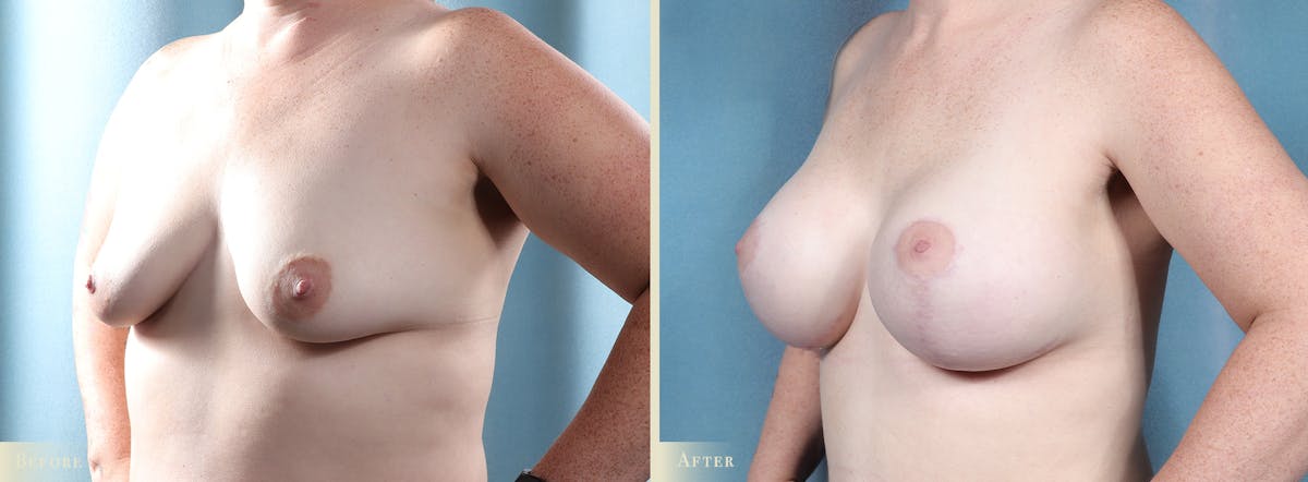 Breast Augmentation and Lift  Before & After Gallery - Patient 437825 - Image 2