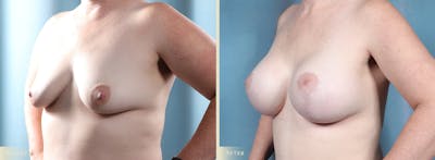 Breast Augmentation and Lift Before & After Gallery - Patient 437825 - Image 2