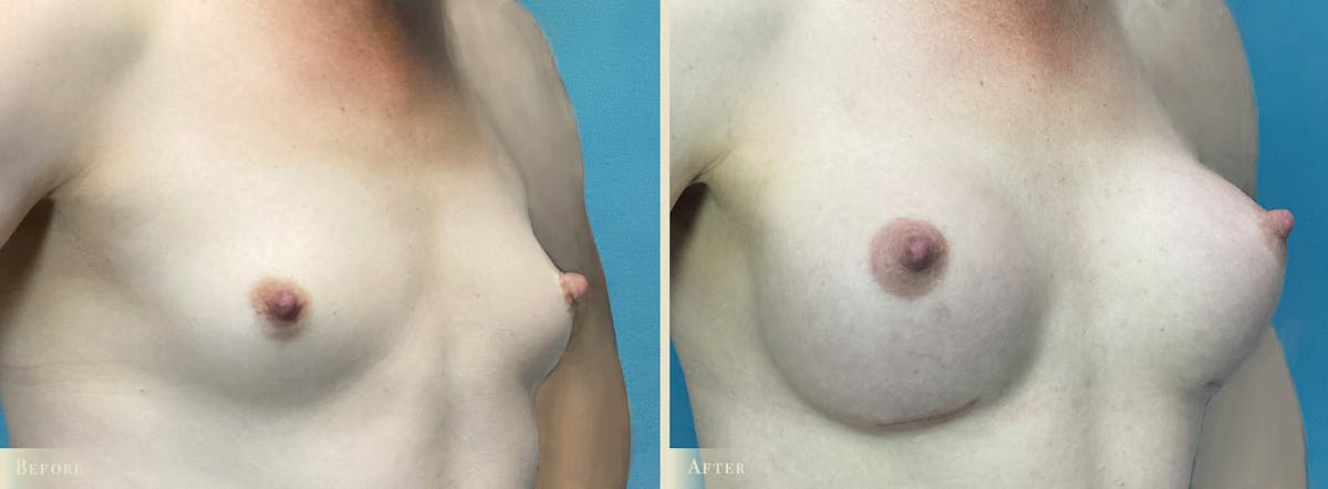 Breast Augmentation Before & After Gallery - Patient 988893 - Image 2