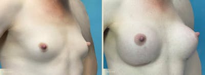 Breast Augmentation Before & After Gallery - Patient 988893 - Image 2