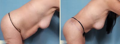 Body Lift Before & After Gallery - Patient 198122 - Image 3