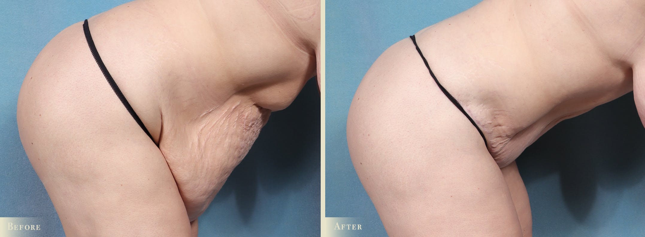 Tummy Tuck Before & After Gallery - Patient 174934 - Image 4
