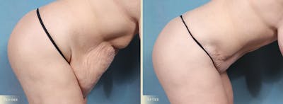 Tummy Tuck Before & After Gallery - Patient 174934 - Image 4
