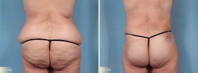 Body Lift Before & After Gallery - Patient 198122 - Image 4