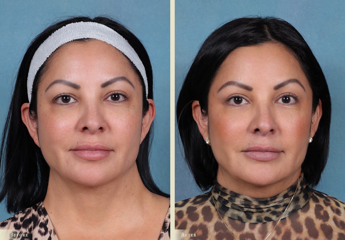 Eyelid Lift Before & After Gallery - Patient 915287 - Image 1