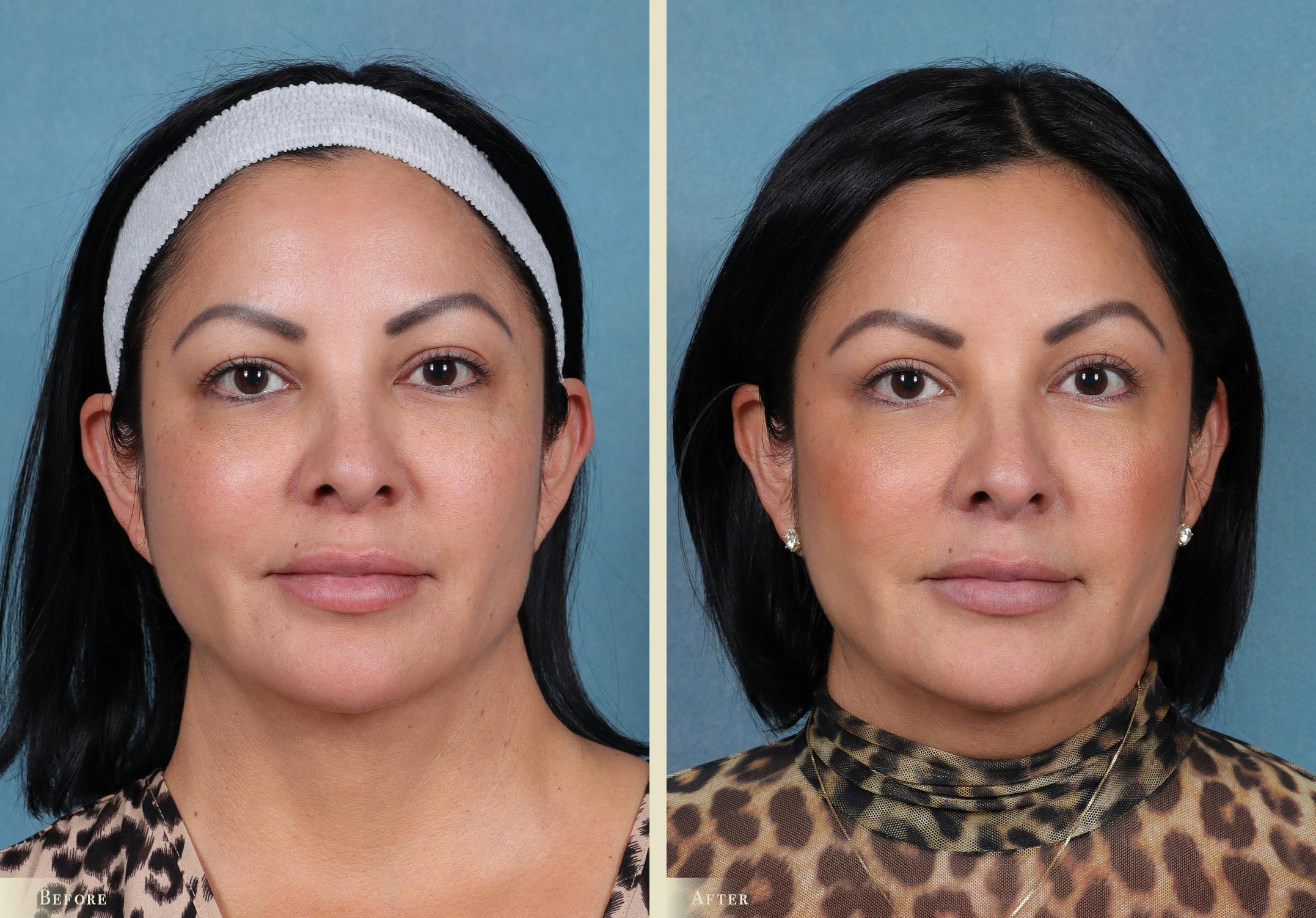 Eyelid Lift Before & After Gallery - Patient 915287 - Image 1