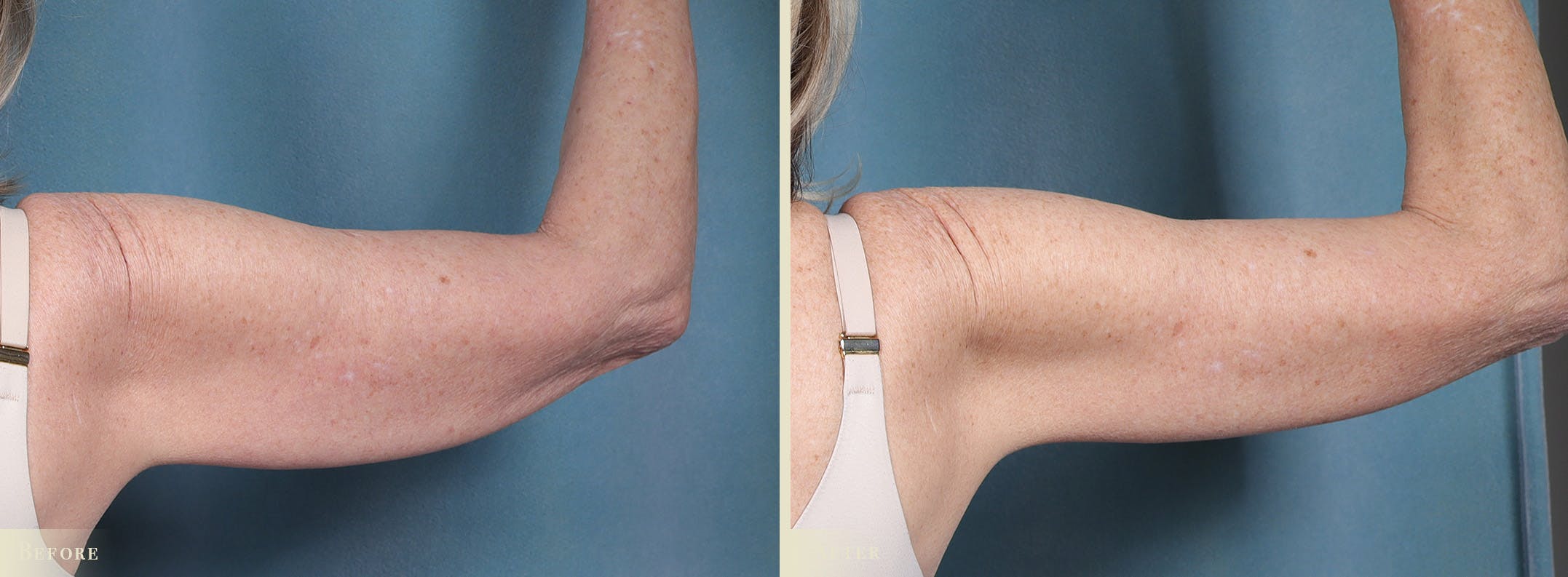 Arm Lift Before & After Gallery - Patient 410869 - Image 2