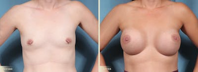 Breast Augmentation Before & After Gallery - Patient 211375 - Image 1
