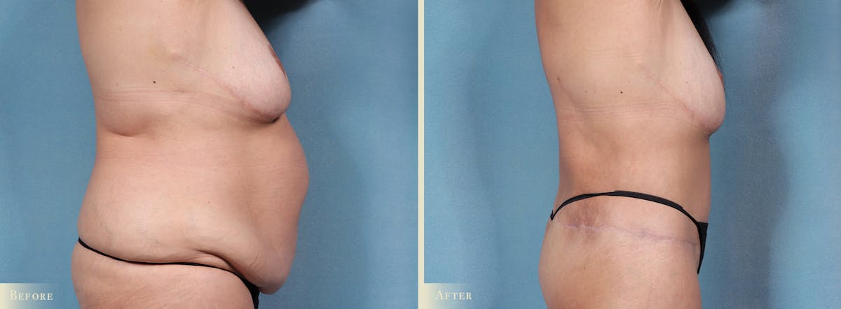 Body Lift Before & After Gallery - Patient 198122 - Image 2