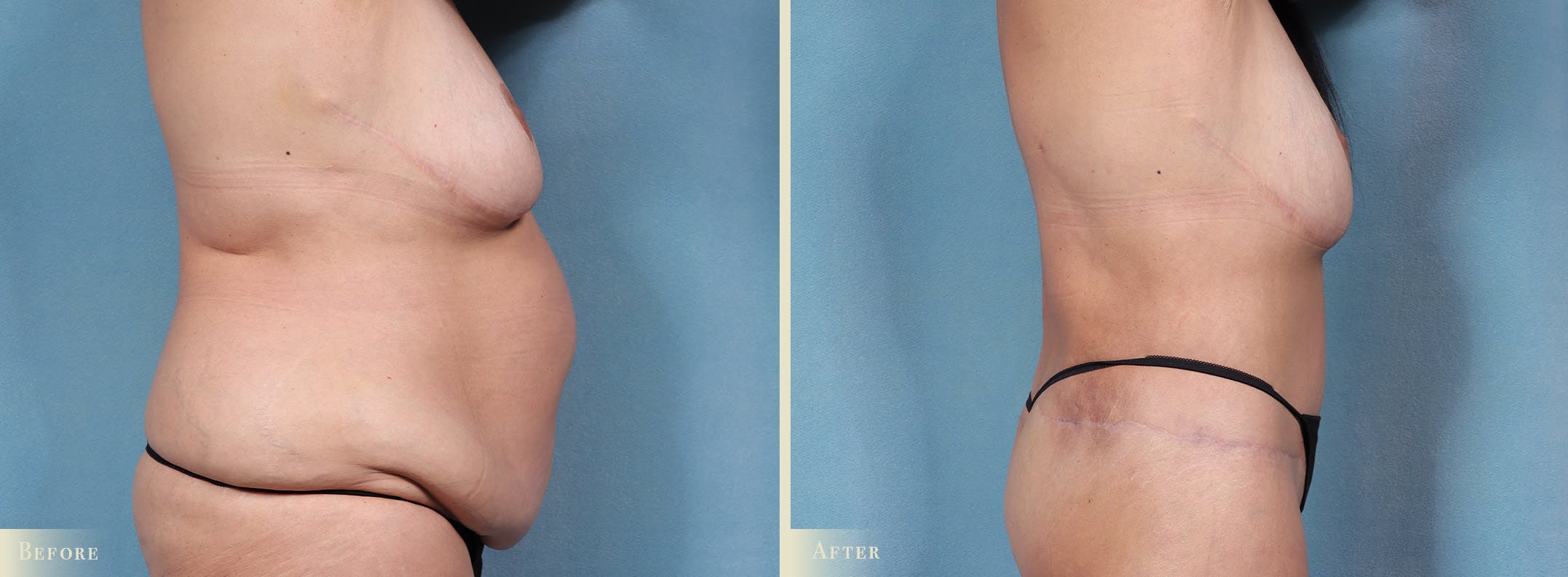 Body Lift Before & After Gallery - Patient 198122 - Image 2