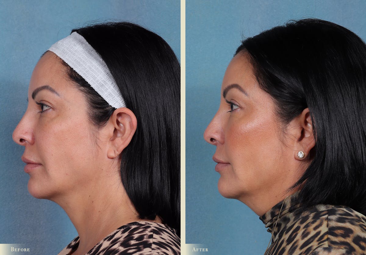 Eyelid Lift Before & After Gallery - Patient 915287 - Image 2