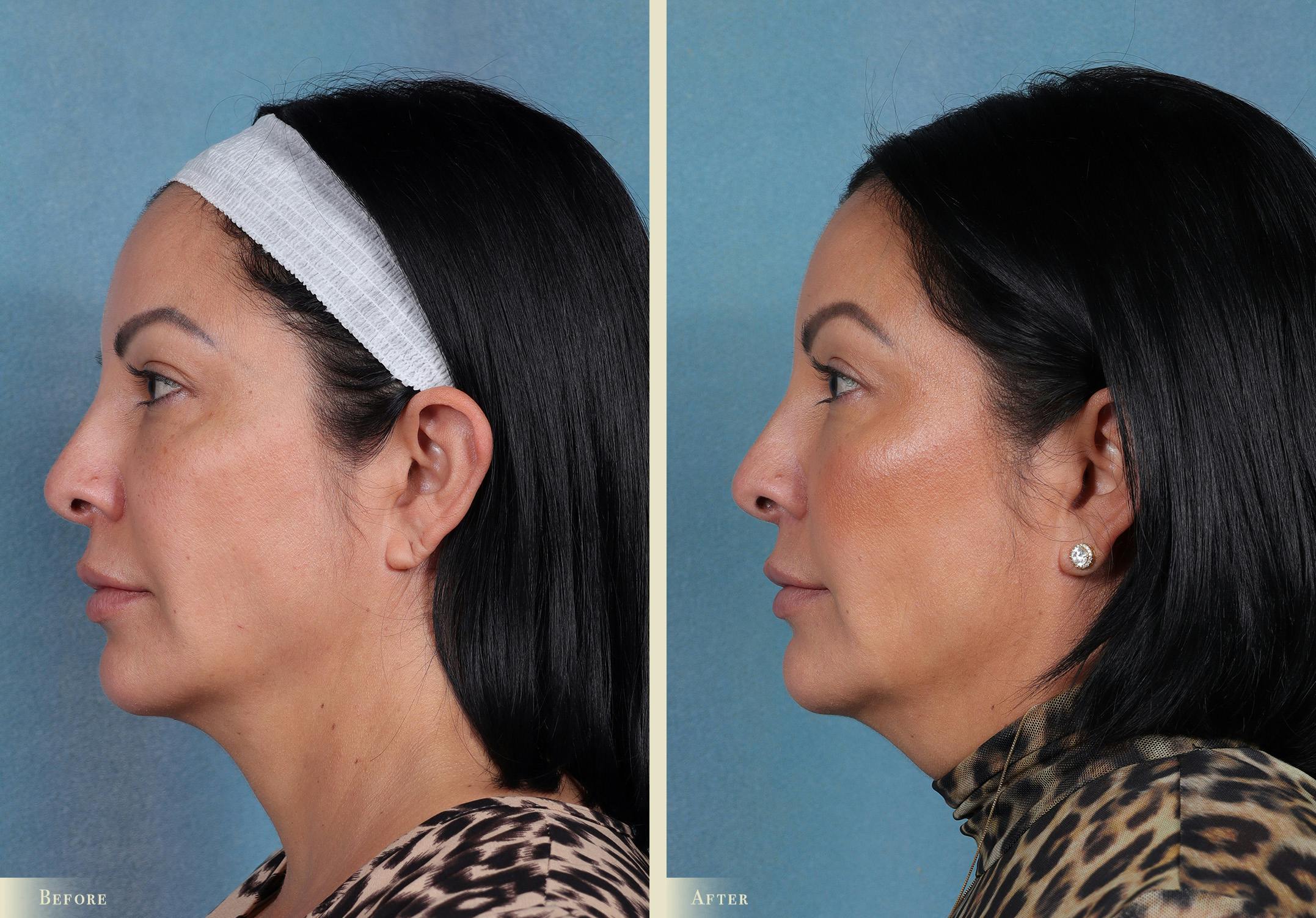 Eyelid Lift Before & After Gallery - Patient 915287 - Image 2