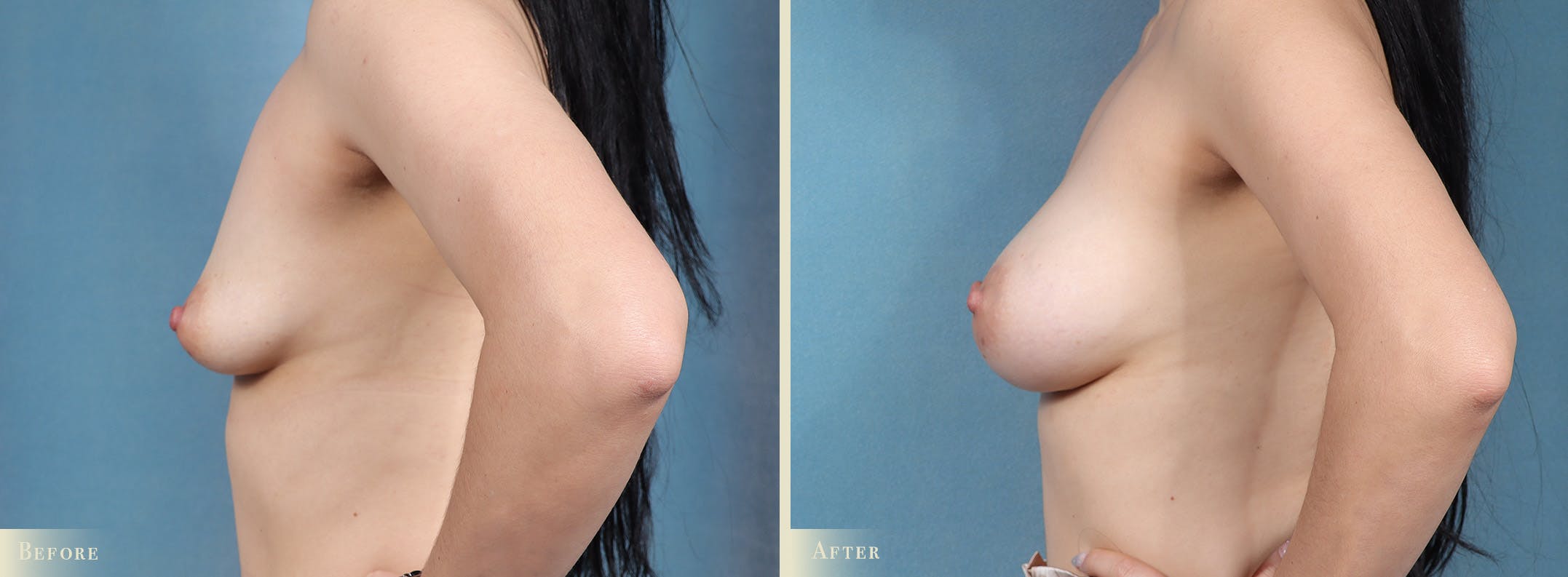 Breast Augmentation Before & After Gallery - Patient 295434 - Image 3