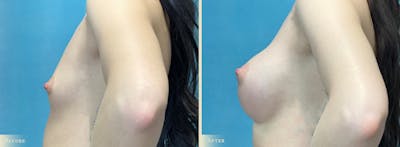 Breast Augmentation Before & After Gallery - Patient 232219 - Image 3