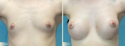 Breast Augmentation Before & After Gallery - Patient 232219 - Image 1