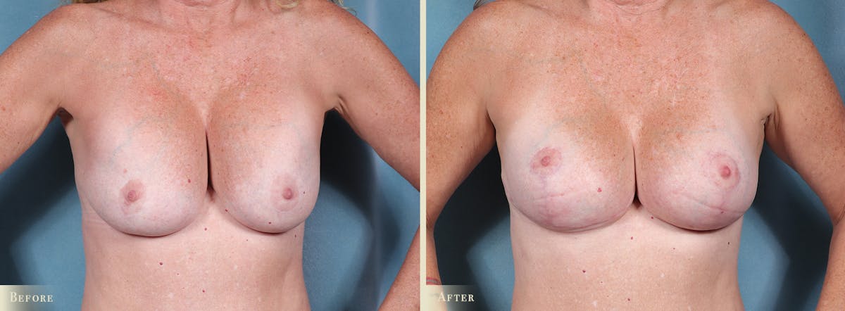 Breast Augmentation and Lift  Before & After Gallery - Patient 268862 - Image 1