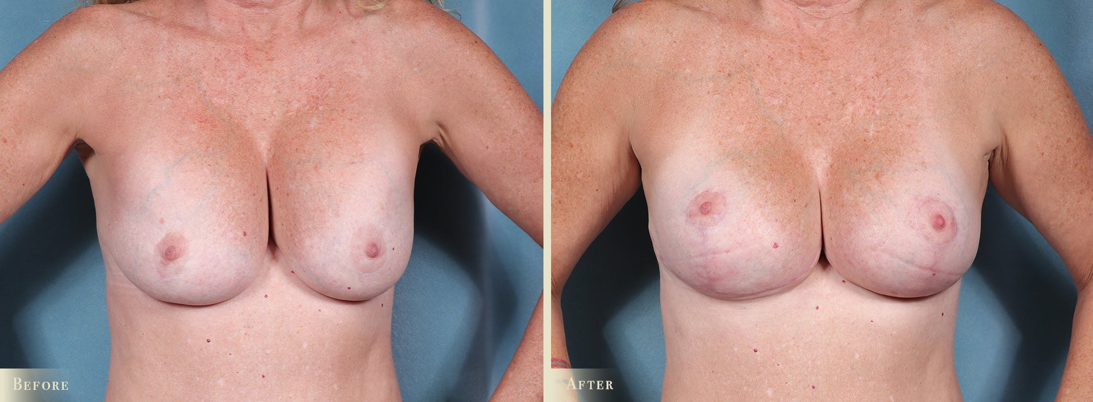 Breast Augmentation and Lift Before & After Gallery - Patient 268862 - Image 1