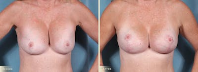 Breast Augmentation and Lift Before & After Gallery - Patient 268862 - Image 1