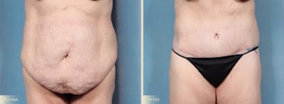 Tummy Tuck Before & After Gallery - Patient 174934 - Image 1