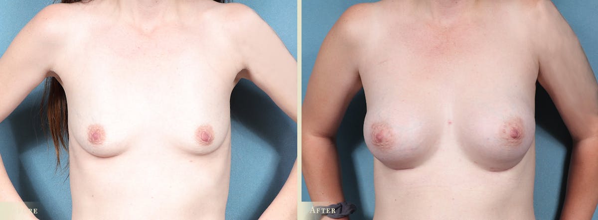 Breast Augmentation Before & After Gallery - Patient 382575 - Image 1