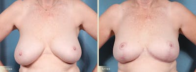 Breast Reduction Before & After Gallery - Patient 321418 - Image 1