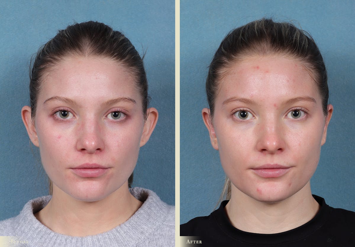 Ear Surgery Before & After Gallery - Patient 245710 - Image 1