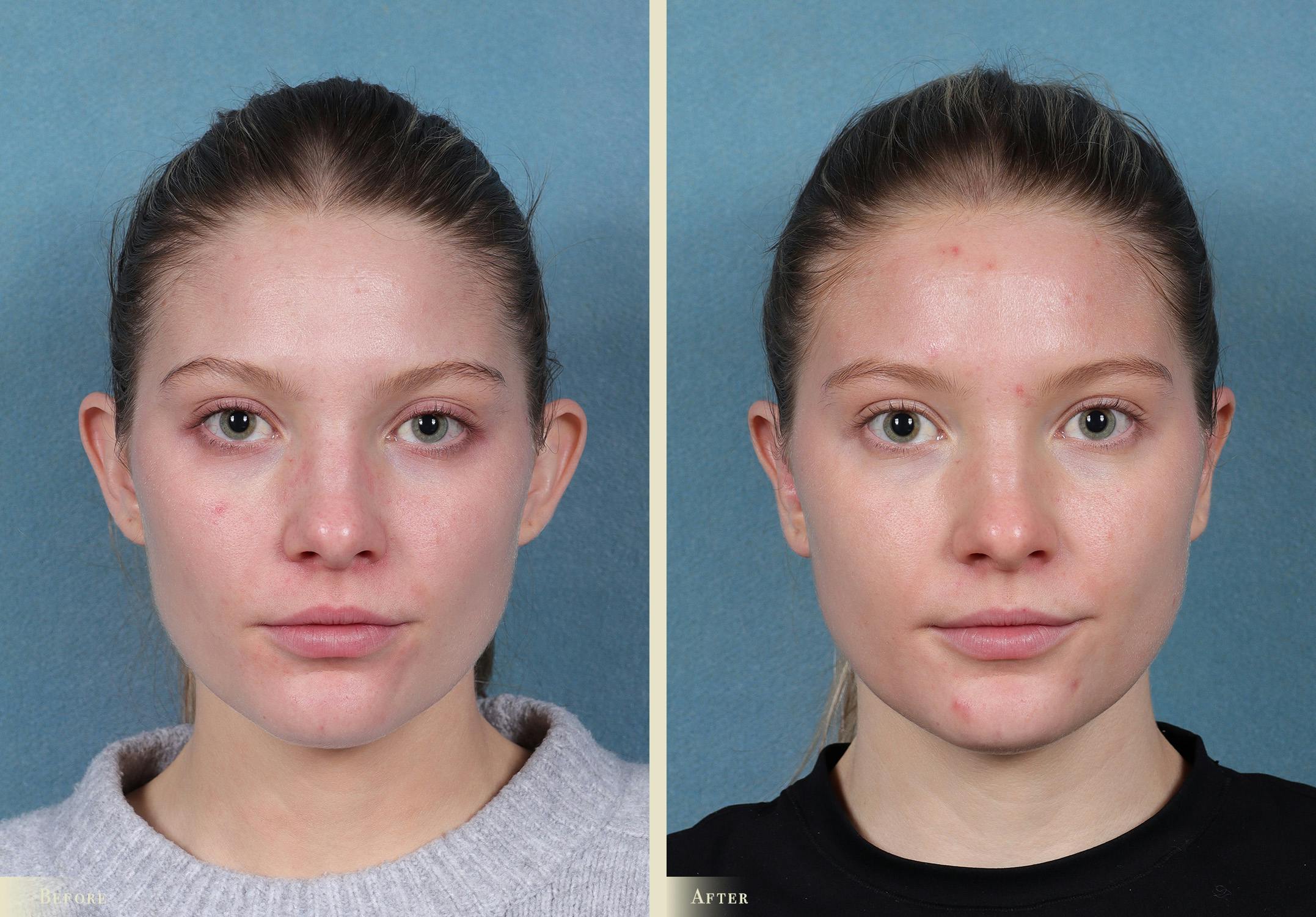 Ear Surgery Before & After Gallery - Patient 245710 - Image 1