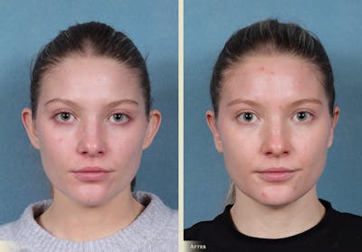 Ear Surgery Before & After Gallery - Patient 245710 - Image 1