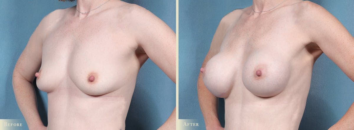 Breast Augmentation Before & After Gallery - Patient 121286 - Image 2