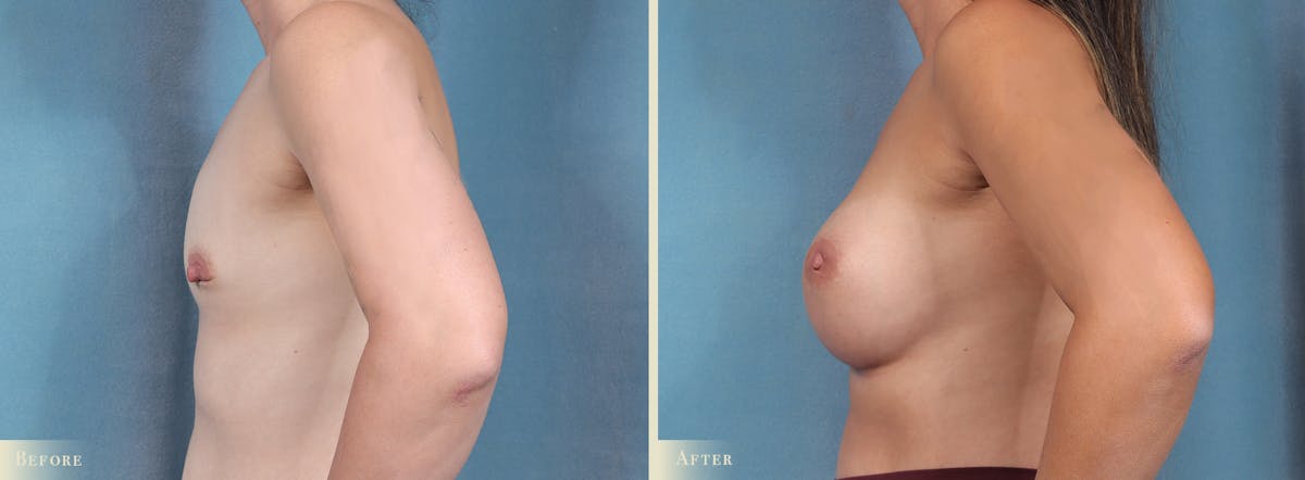 Breast Augmentation Before & After Gallery - Patient 211375 - Image 3