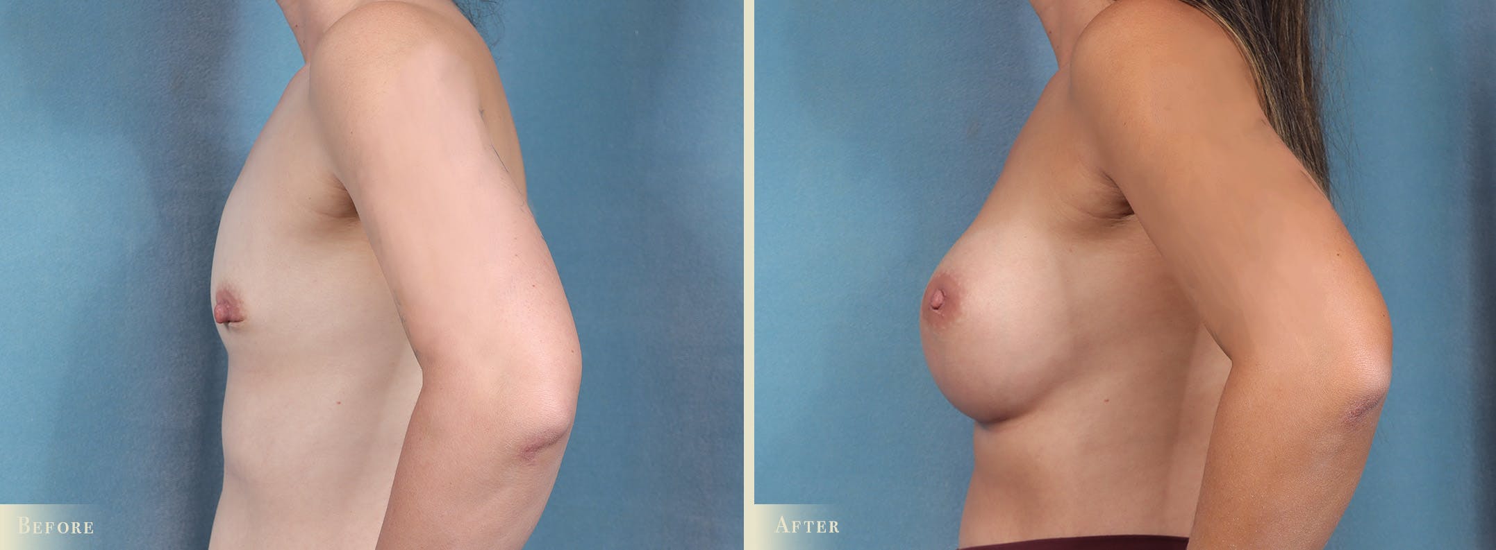 Breast Augmentation Before & After Gallery - Patient 211375 - Image 3