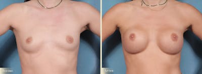 Breast Augmentation Before & After Gallery - Patient 358310 - Image 1