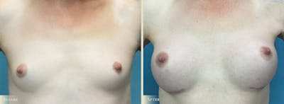 Breast Augmentation Before & After Gallery - Patient 988893 - Image 1