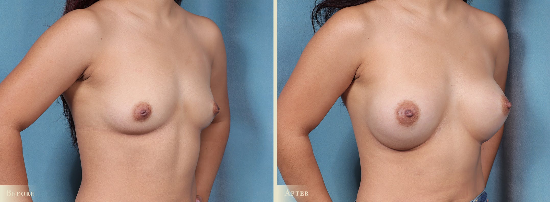 Breast Augmentation Before & After Gallery - Patient 389637 - Image 2