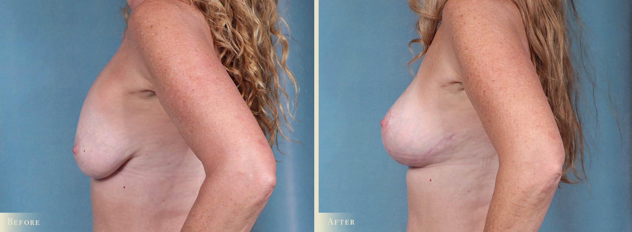 Breast Augmentation and Lift Before & After Gallery - Patient 268862 - Image 3