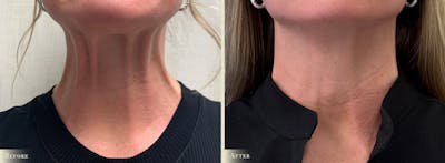 Botox® and Fillers Before & After Gallery - Patient 170519 - Image 1