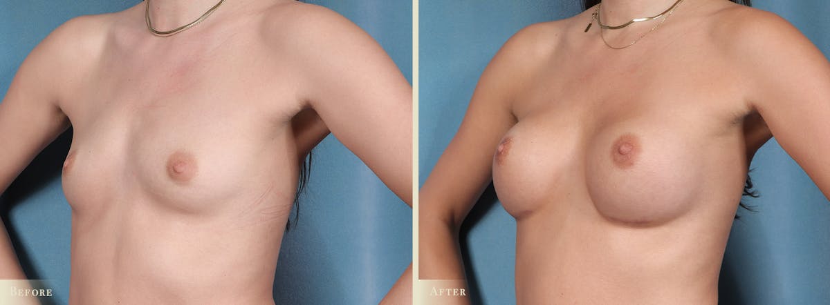 Breast Augmentation Before & After Gallery - Patient 358310 - Image 2