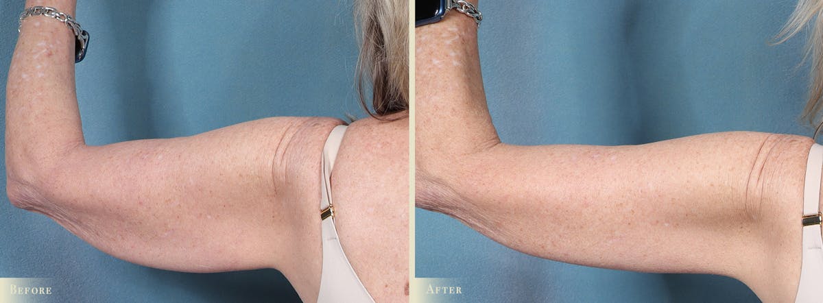Arm Lift Before & After Gallery - Patient 410869 - Image 3