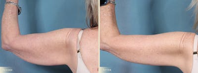 Arm Lift Before & After Gallery - Patient 410869 - Image 3