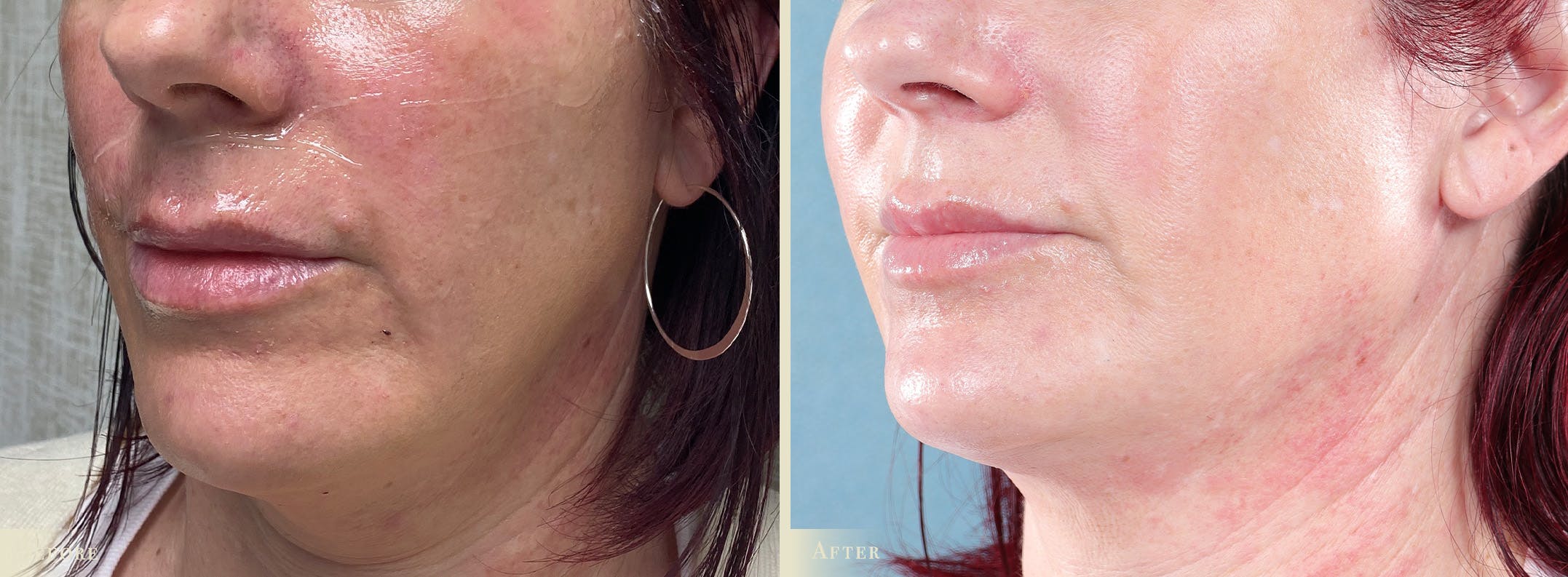 Lip Augmentation Before & After Gallery - Patient 420629 - Image 2