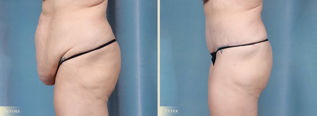 Tummy Tuck Before & After Gallery - Patient 174934 - Image 3