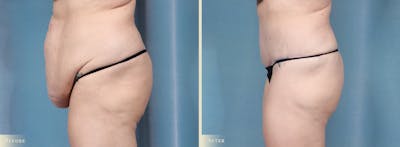Tummy Tuck Before & After Gallery - Patient 174934 - Image 3